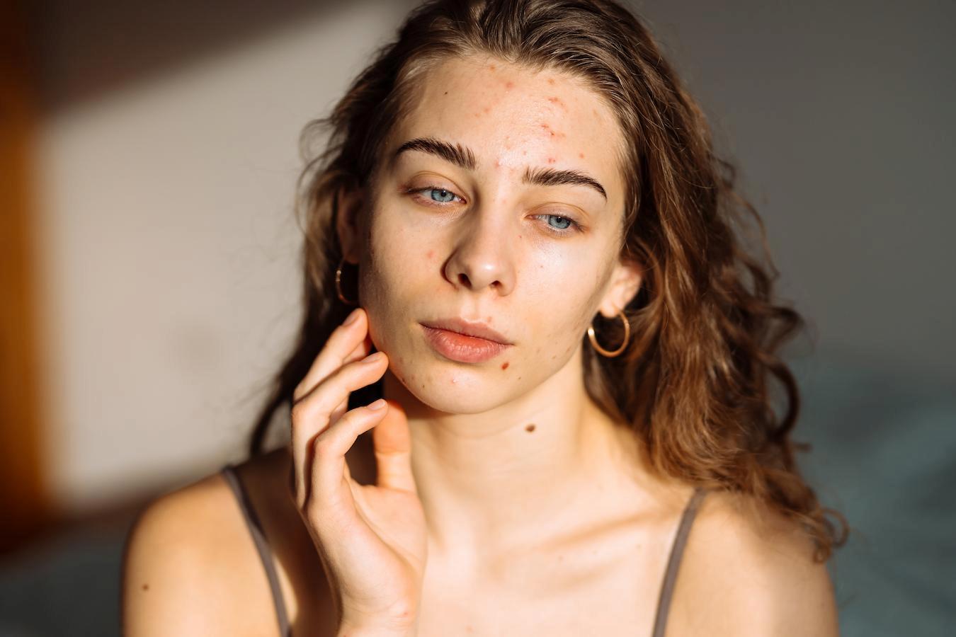 Why Am I Still Breaking Out With A Good Skincare Routine