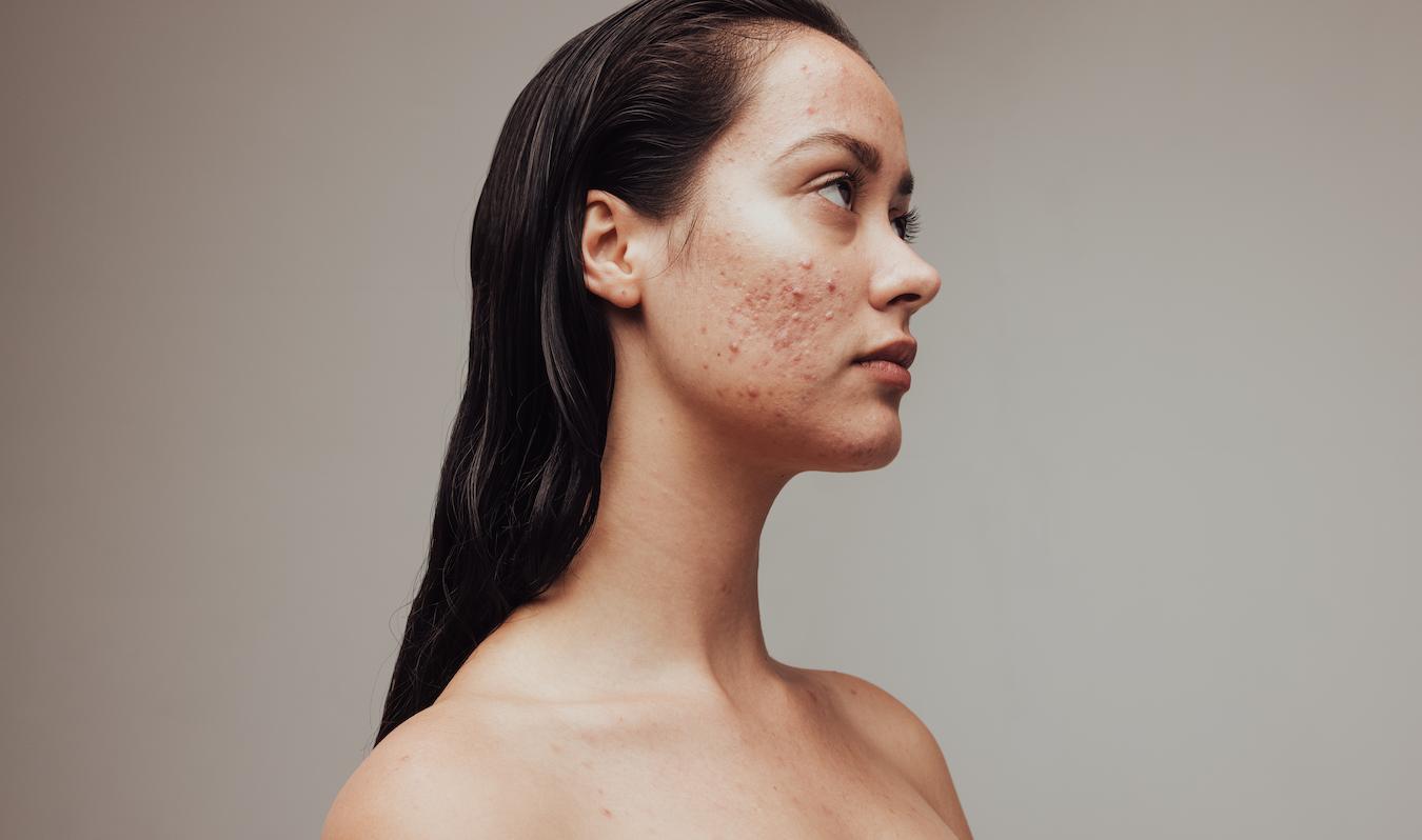 How To Know If Your Skin Barrier Is Damaged