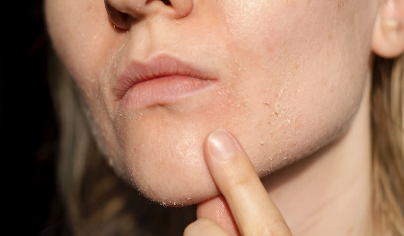 Why Is My Skin Peeling
